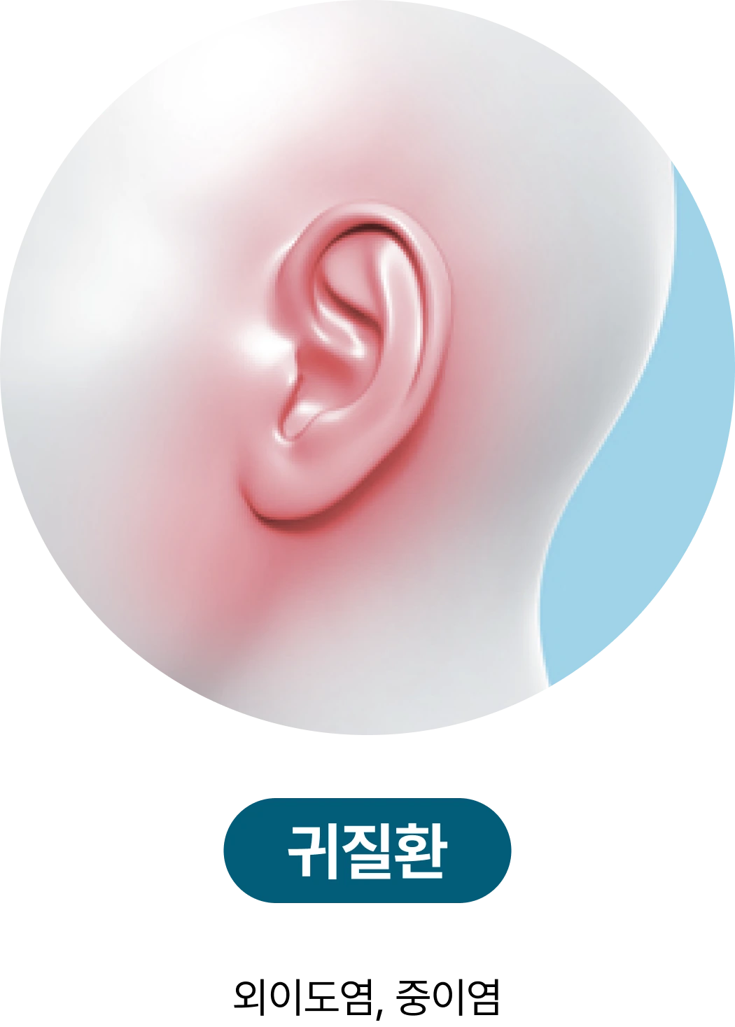 귀질환: 외이도염, 중이염